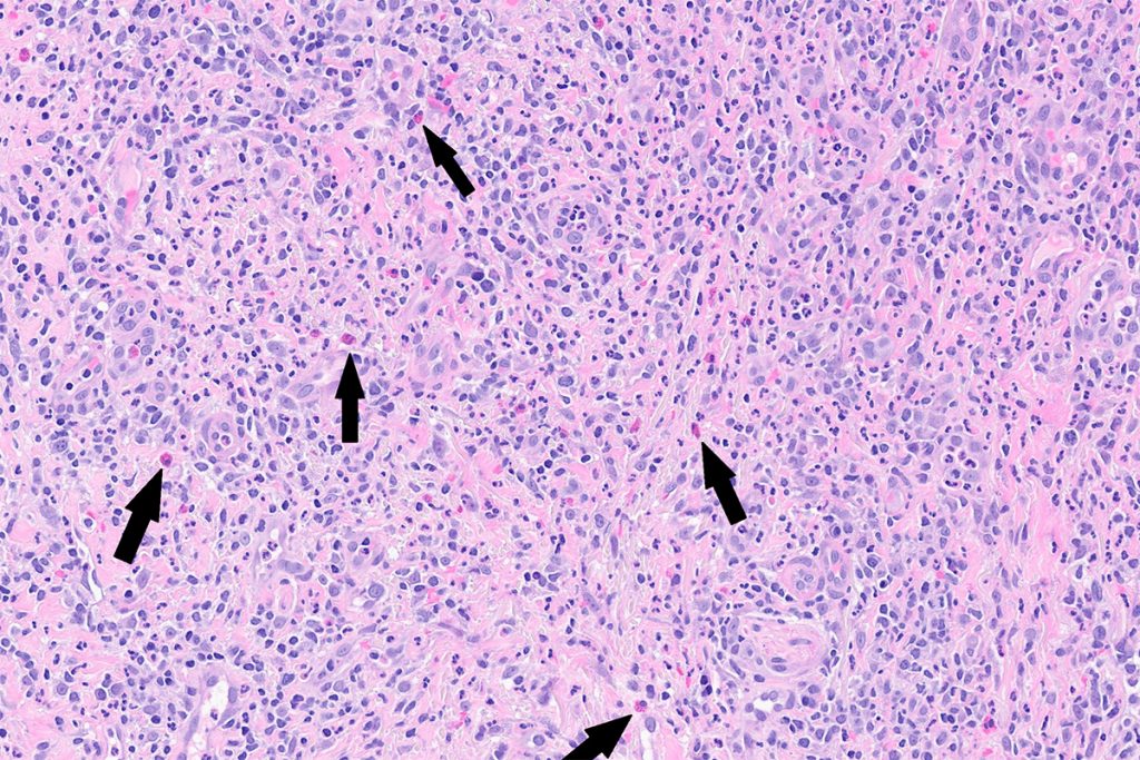 Histologinen kuva haavamuutoksesta